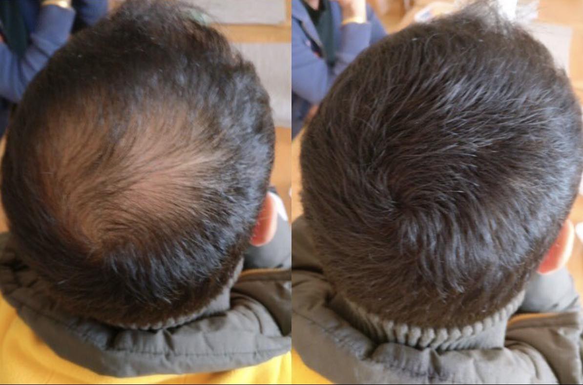 Thin hair solution - Hair Loss - Hair Fibres - Hair building fibers