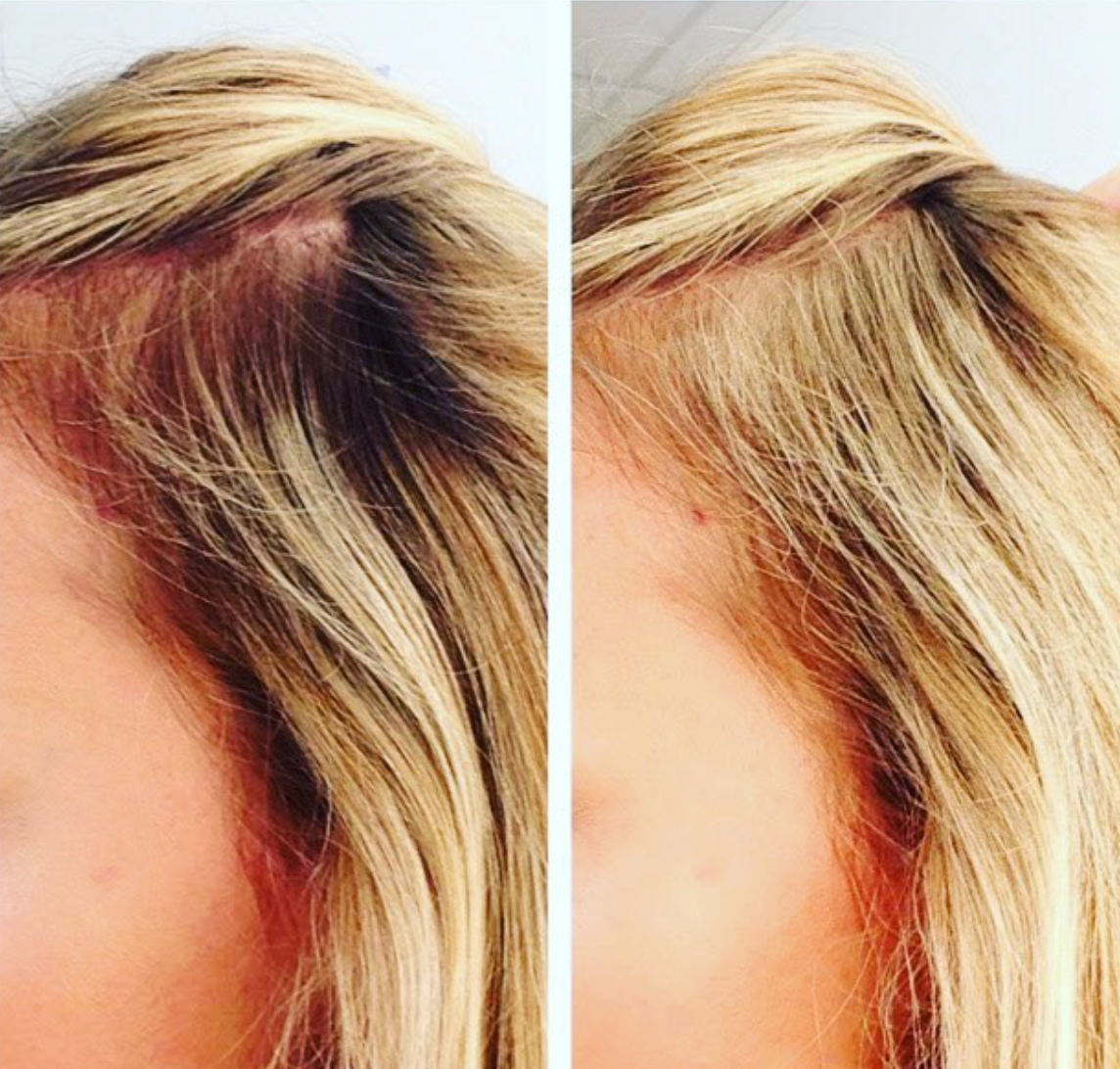 Root Cover Up